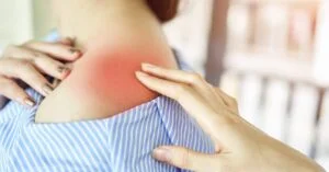 inflammation